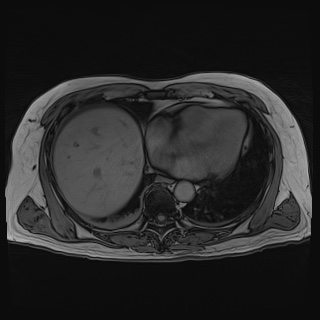 Acute cholecystitis (Radiopaedia 72392-82923 Axial T1 out-of-phase 18).jpg