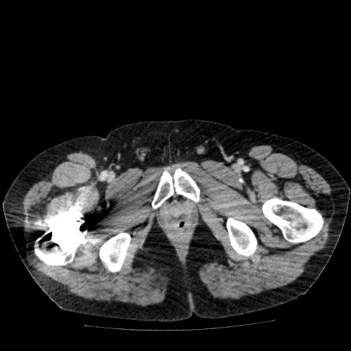 File:Acute cholecystitis and incidental left sided IVC (Radiopaedia 49352-54459 Axial C+ portal venous phase 161).jpg