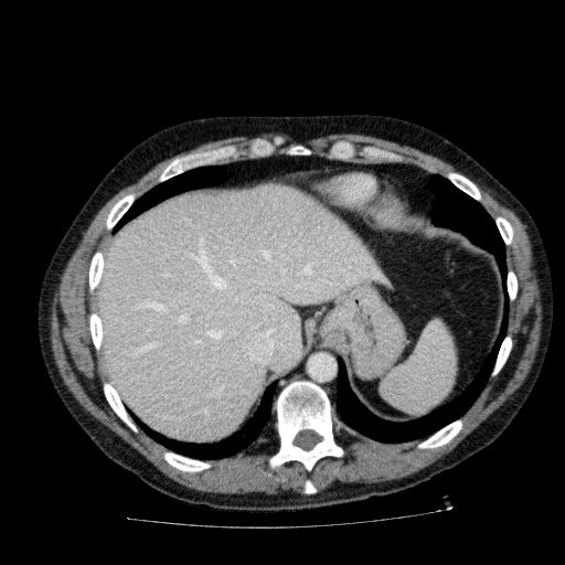 Acute cholecystitis and incidental left sided IVC (Radiopaedia 49352-54459 Axial C+ portal venous phase 33).jpg