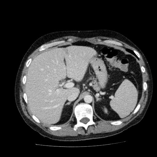 Acute cholecystitis and incidental left sided IVC (Radiopaedia 49352-54459 Axial C+ portal venous phase 44).jpg