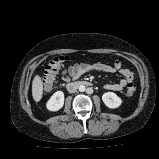File:Acute cholecystitis and incidental left sided IVC (Radiopaedia 49352-54459 Axial C+ portal venous phase 77).jpg
