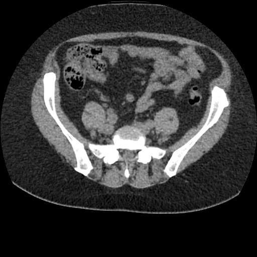 Acute cholecystitis and ureteric colic (Radiopaedia 42330-45444 Axial prone 74).jpg