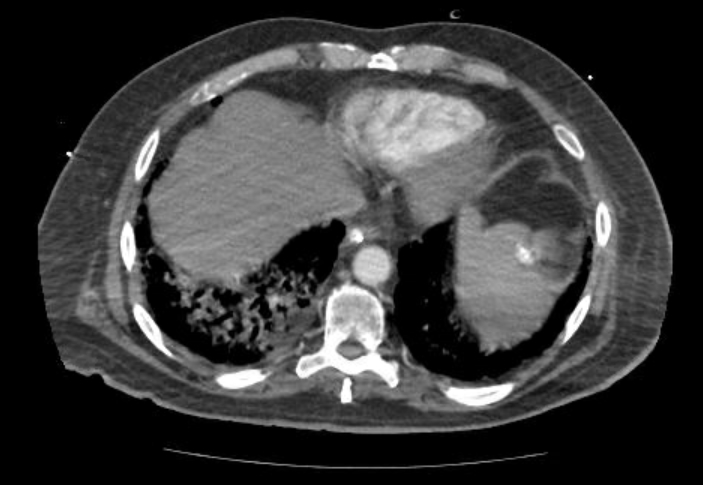 Acute cor pulmonale (ultrasound) (Radiopaedia 83508-98818 Axial C+ CTPA 62).jpg