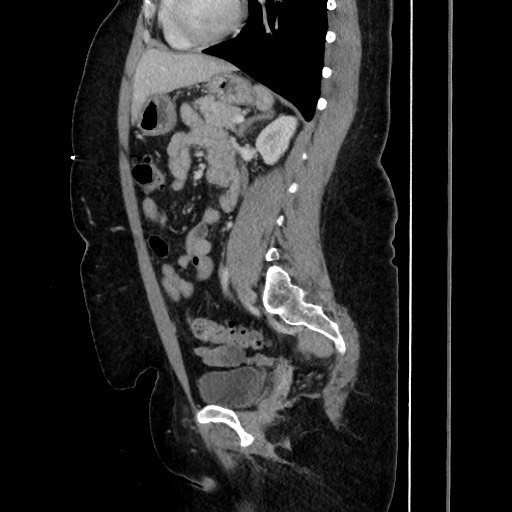 Acute diverticulitis - transverse colon (Radiopaedia 87063-103327 Sagittal C+ portal venous phase 140).jpg