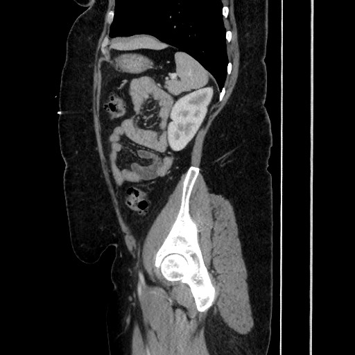 Acute diverticulitis - transverse colon (Radiopaedia 87063-103327 Sagittal C+ portal venous phase 163).jpg