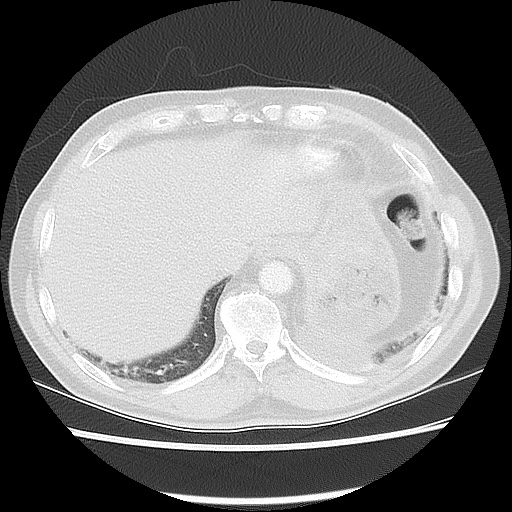 Acute epicardial fat necrosis (Radiopaedia 42327-45440 Axial lung window 47).jpg