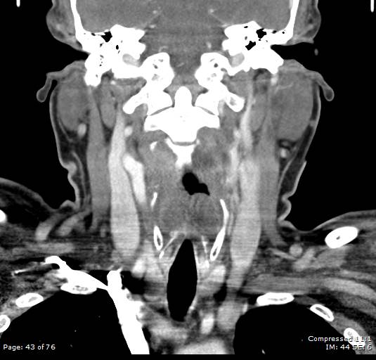 Acute epiglottitis (Radiopaedia 54375-60590 Coronal C+ arterial phase 43).jpg