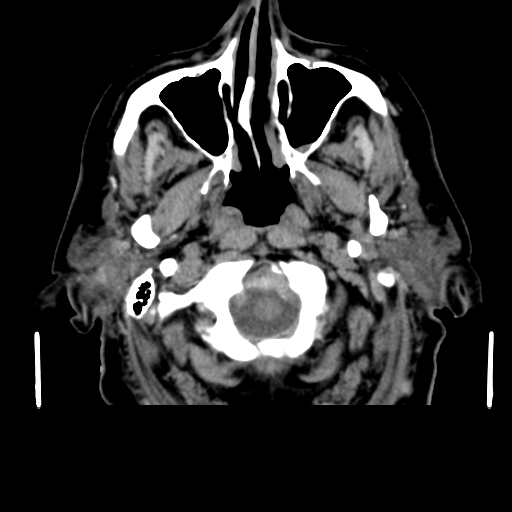 Acute hemorrhagic stroke (Radiopaedia 17507-17223 Axial non-contrast 5).jpg