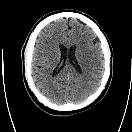 Acute left middle cerebral artery territory ischemic stroke (Radiopaedia 35688-37223 Axial non-contrast 49).png