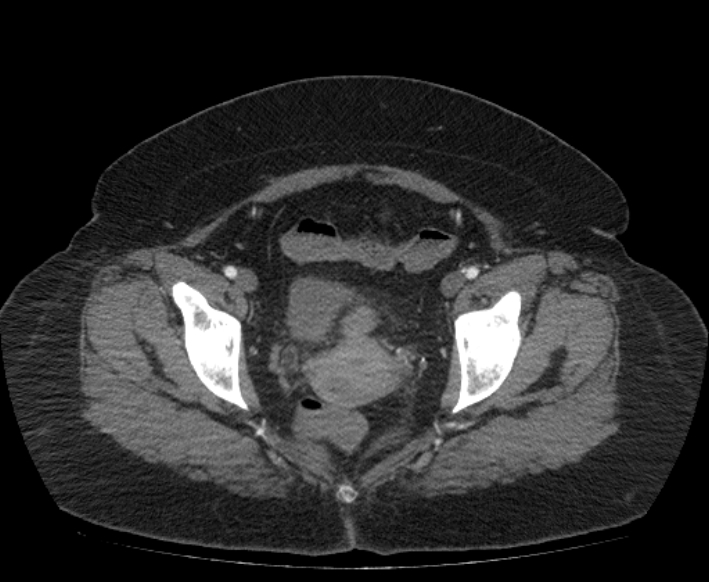 Acute mesenteric ischemia (Radiopaedia 80029-93316 Axial C+ arterial phase 121).jpg