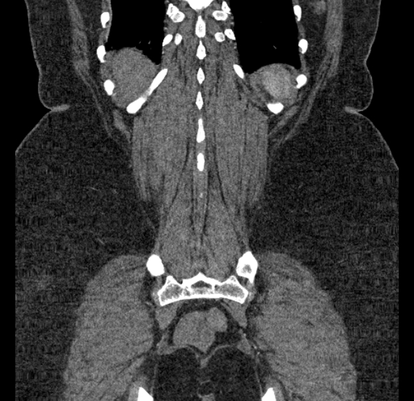 Acute mesenteric ischemia (Radiopaedia 80029-93316 Coronal C+ arterial phase 123).jpg