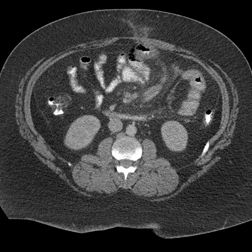 File:Acute mesenteric venous ischemia (Radiopaedia 46041-50383 Axial C+ portal venous phase 58).jpg