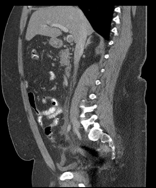 Acute mesenteric venous ischemia (Radiopaedia 46041-50383 Sagittal C+ portal venous phase 49).jpg