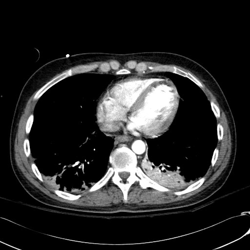 File:Acute myocardial infarction in CT (Radiopaedia 39947-42415 Axial C+ arterial phase 99).jpg