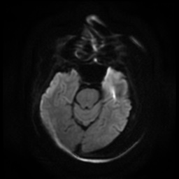 Acute otitis externa (Radiopaedia 57296-64236 Axial DWI 3).jpg