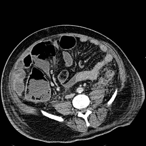 Acute pancreatic necrosis (Radiopaedia 13560-18501 Axial C+ portal venous phase 92).jpg