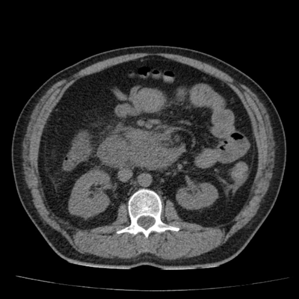 Acute pancreatitis (Radiopaedia 26663-26813 Axial non-contrast 47).jpg
