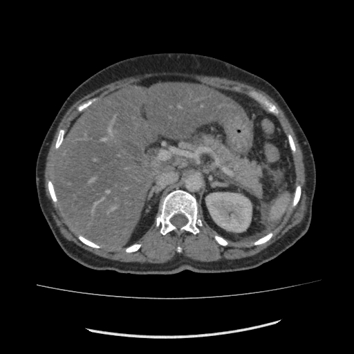 Acute pancreatitis (Radiopaedia 80007-93285 Axial C+ portal venous phase 43).jpg