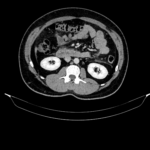 Acute pancreatitis (Radiopaedia 87428-103757 Axial C+ portal venous phase 47).jpg