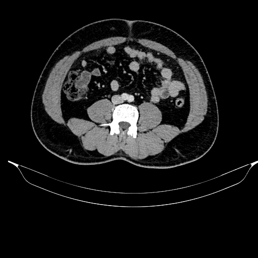 File:Acute pancreatitis (Radiopaedia 87428-103757 Axial C+ portal venous phase 61).jpg
