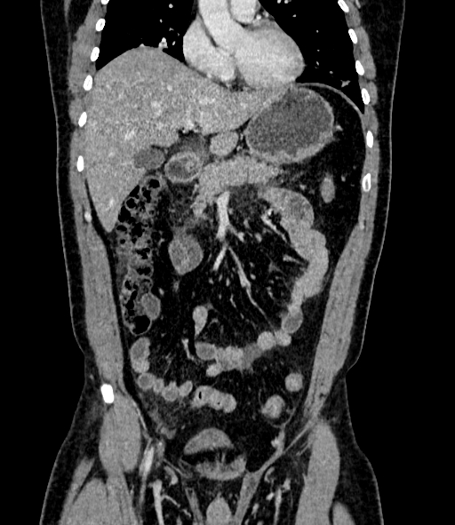 Acute pancreatitis (Radiopaedia 87428-103757 Coronal C+ portal venous phase 35).jpg