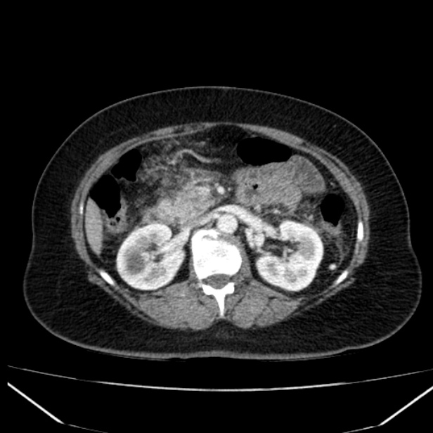 Acute pancreatitis - Balthazar C (Radiopaedia 26569-26714 Axial C+ arterial phase 37).jpg
