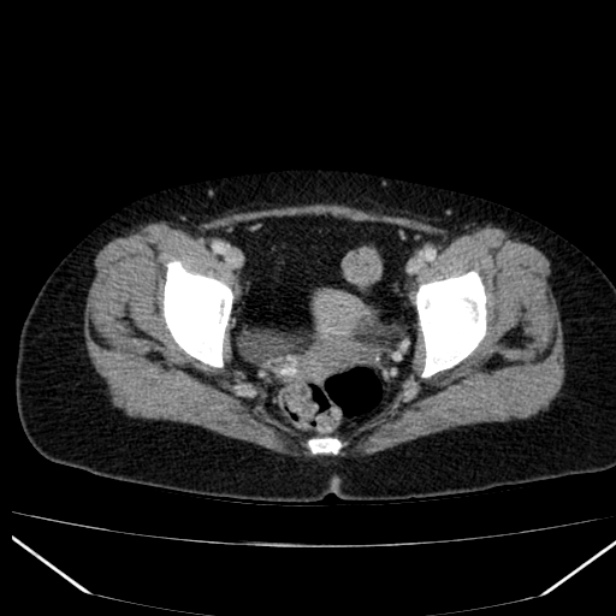 Acute pancreatitis - Balthazar C (Radiopaedia 26569-26714 Axial C+ portal venous phase 87).jpg