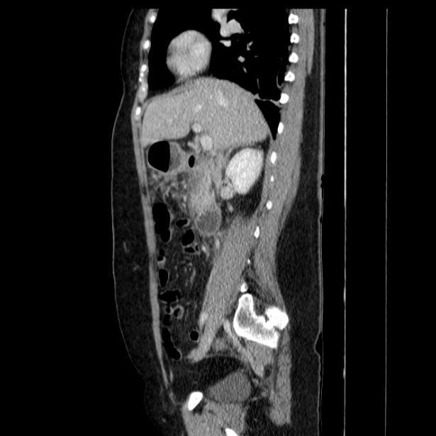 Acute pancreatitis - Balthazar C (Radiopaedia 26569-26714 Sagittal C+ portal venous phase 28).jpg