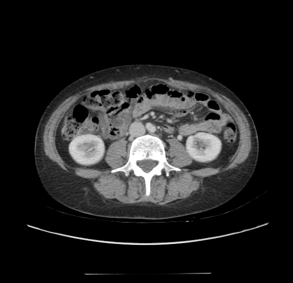 Acute pancreatitis - Balthazar E - post ERCP (Radiopaedia 27562-27772 Axial C+ portal venous phase 42).png