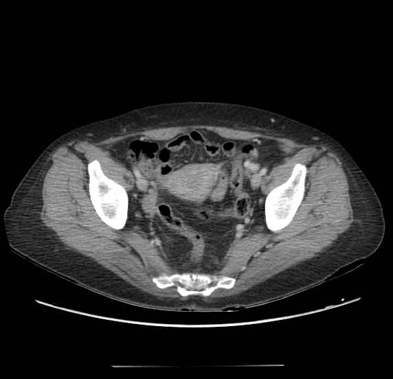 File:Acute pancreatitis - Balthazar E - post ERCP (Radiopaedia 27562-27772 Axial C+ portal venous phase 66).png