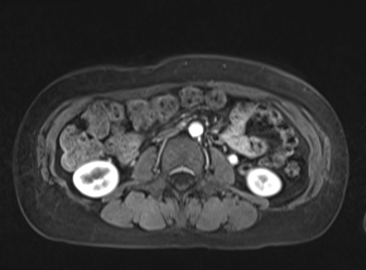 Acute pancreatitis - Balthazar E - post ERCP (Radiopaedia 27562-27778 Axial VIBE C+ 67).png