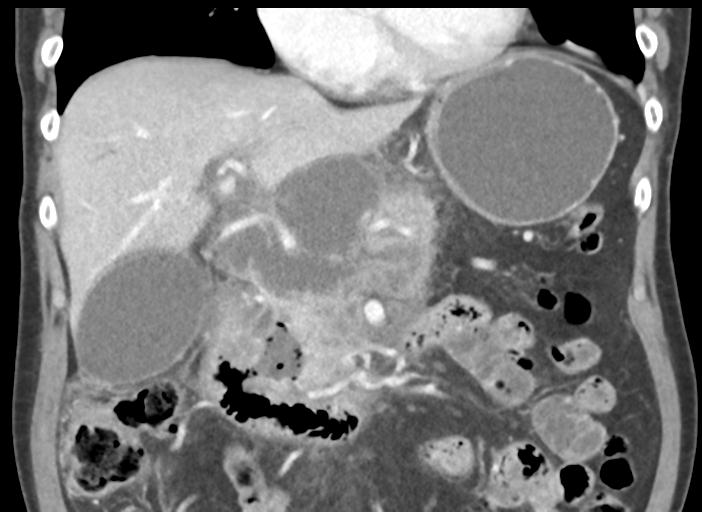 Acute pancreatitis and walled-off necrosis (Radiopaedia 29888-30404 Coronal C+ portal venous phase 23).jpg