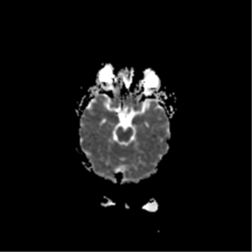 File:Acute pontine infarct from vertebral artery dissection (Radiopaedia 34111-35370 Axial ADC 8).png