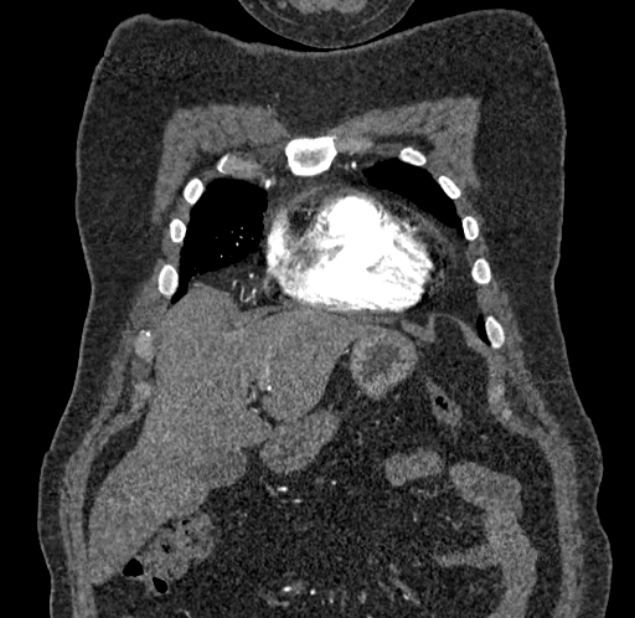 Acute pulmonary embolism with pulmonary infarcts (Radiopaedia 77688-89908 Coronal C+ CTPA 3).jpg