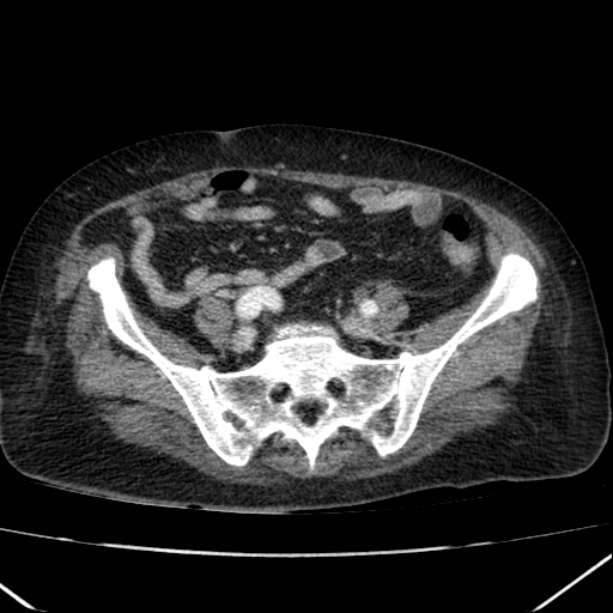 Acute pyelonephritis (Radiopaedia 26584-26729 Axial renal cortical phase 55).jpg
