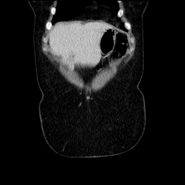 Acute pyelonephritis (Radiopaedia 33397-34434 Coronal renal parenchymal phase 18).jpg