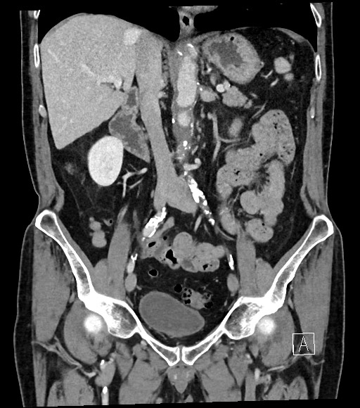 Acute renal infarction (Radiopaedia 59375-66736 Coronal C+ portal venous phase 32).jpg