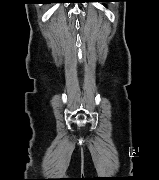 Acute renal infarction (Radiopaedia 59375-66736 Coronal C+ portal venous phase 58).jpg