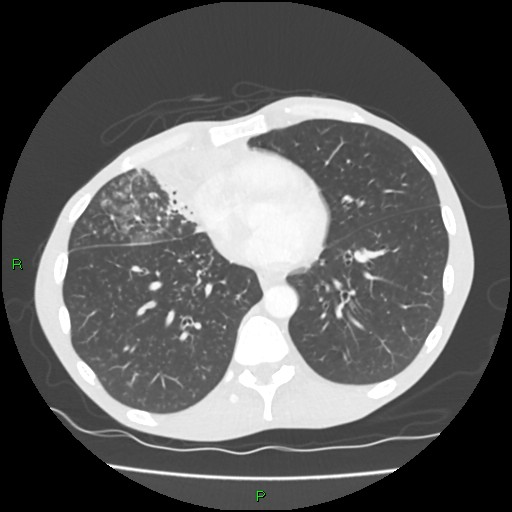 Acute right lung abscess (Radiopaedia 34806-36258 Axial lung window 123).jpg