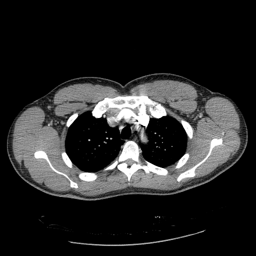 Acute segmental pulmonary emboli and pulmonary infarction (Radiopaedia 62264-70444 Axial C+ CTPA 31).jpg