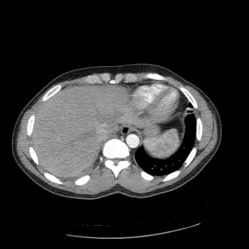 Acute segmental pulmonary emboli and pulmonary infarction (Radiopaedia 62264-70444 Axial C+ CTPA 95).jpg