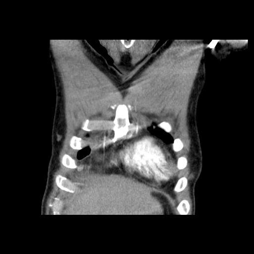 File:Acute segmental pulmonary emboli and pulmonary infarction (Radiopaedia 62264-70444 Coronal C+ CTPA 1).jpg