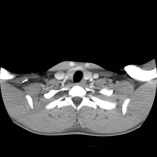 File:Acute submandibular sialadenitis secondary to ductal stone (Radiopaedia 27999-28267 Axial C+ delayed 42).jpg
