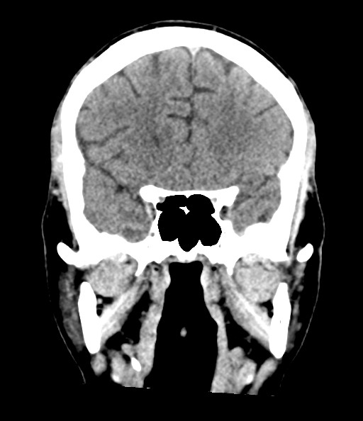Acute superior cerebellar artery territory infarct (Radiopaedia 84104-99359 Coronal non-contrast 39).jpg