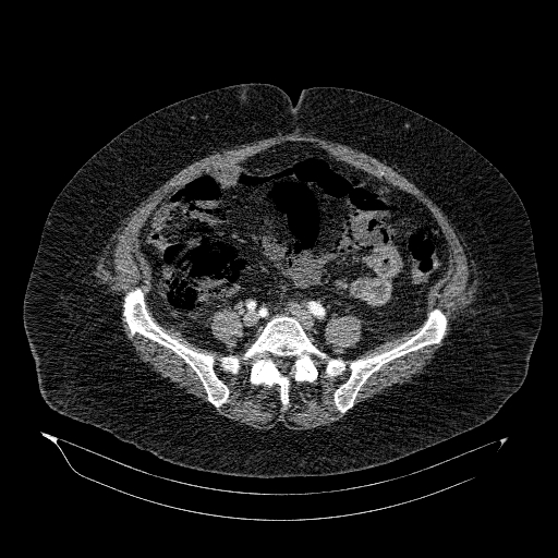 File:Acute superior mesenteric artery occlusion (Radiopaedia 51288-56960 Axial C+ arterial phase 64).jpg
