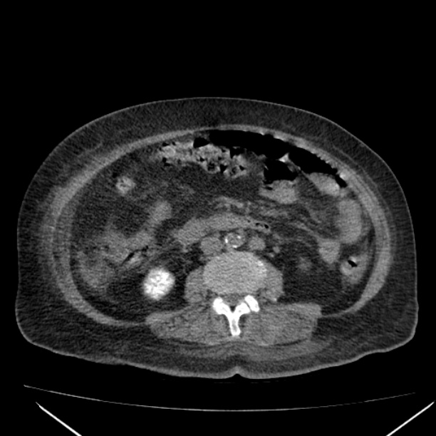 Acute tubular necrosis (Radiopaedia 28077-28334 Axial non-contrast 37).jpg