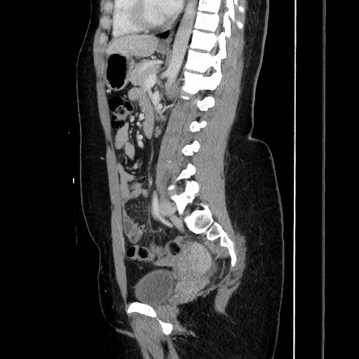 File:Acute uncomplicated appendicitis (Radiopaedia 73704-84499 Sagittal C+ portal venous phase 124).jpg