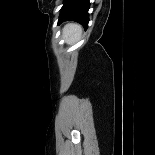 Acute uncomplicated appendicitis (Radiopaedia 73704-84499 Sagittal C+ portal venous phase 176).jpg