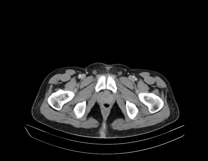 Addison disease (Radiopaedia 49318-54412 Axial C+ portal venous phase 76).jpg