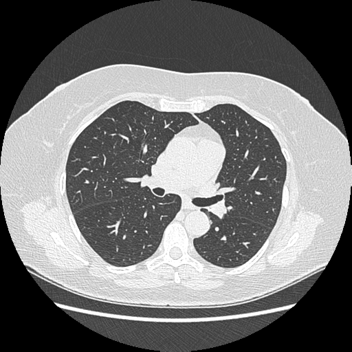 Adenocarcinoma in situ of lung (Radiopaedia 38685-40829 B 103).png